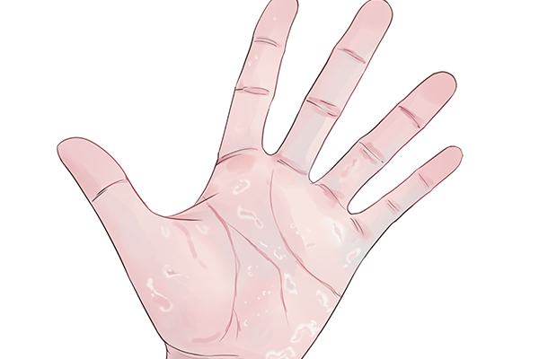 手上脫皮怎么治療