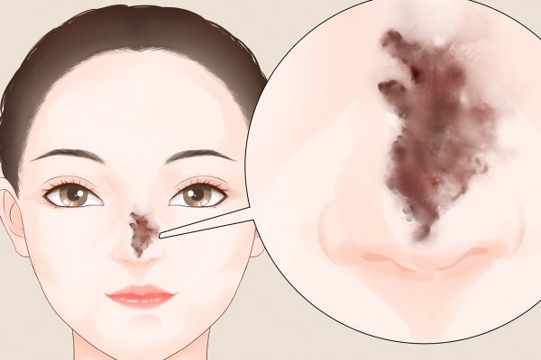 隆鼻手術(shù)的風(fēng)險大嗎