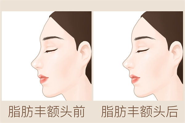 額頭有皺紋怎么回事