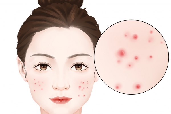 怎么去掉臉上的青春痘