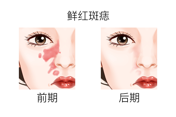 激光去痣后注意事項-易網健康<a href=http://www.gyfww.com/jkys/ target=_blank class=infotextkey>養生</a>網 激光去痣后注意事項