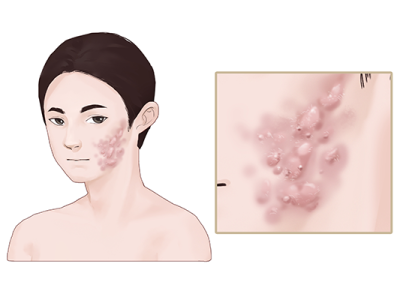 臉上的痘坑怎么修復(fù)