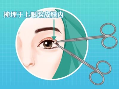 雙眼皮做手術一般價錢