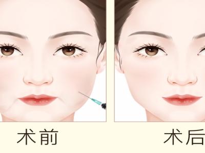 打溶脂針有副作用嗎