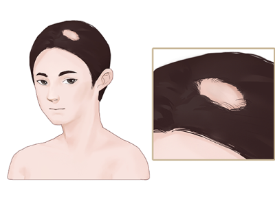 油脂性脫發該怎么辦