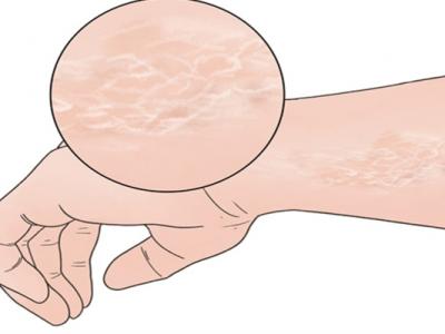 秋季皮膚干燥怎么辦