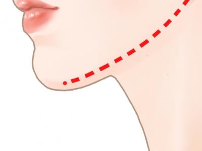 去掉下頜角有什么方法