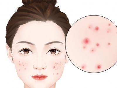 怎么去掉臉上的青春痘