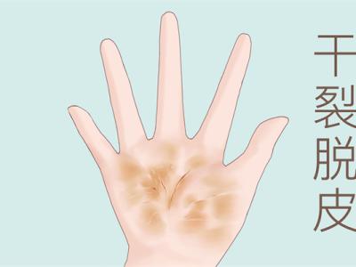秋季手干怎么辦