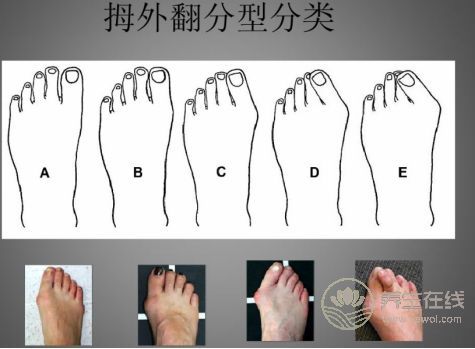 春季我們應該如何預防大腳骨