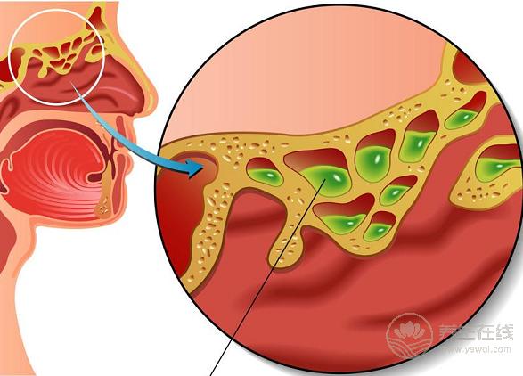 秋季鼻炎犯了,可別當感冒治,4招可以預防改善 秋季鼻炎犯了,可別當感冒治,4招可以預防改善