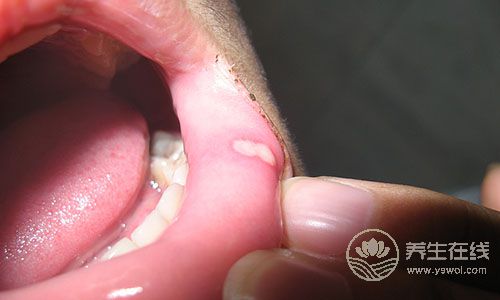 夏天口腔潰瘍怎么辦？5種水果助你排毒治病