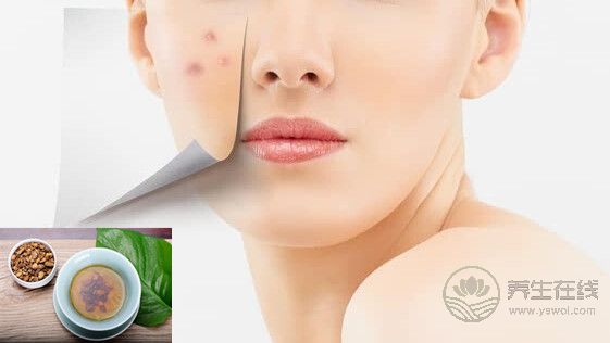 秋燥上火“痘痘”長(zhǎng)，去痘要分虛實(shí)治