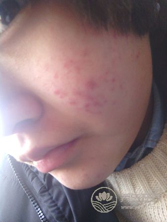 長(zhǎng)青春痘怎么辦？不同位置有不同藥方
