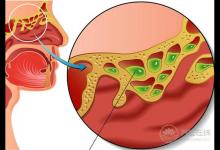 秋季鼻炎犯了，可別當感冒治，4招可以預防改善