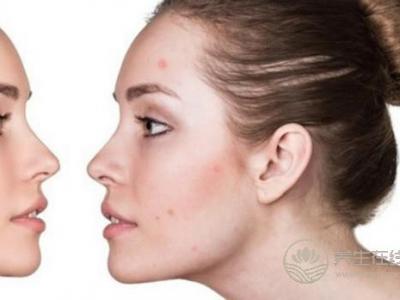 春節(jié)后痘痘為何來勢洶洶