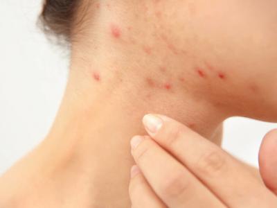 春天臉過敏怎么補水，想讓痘痘消失也并不難!