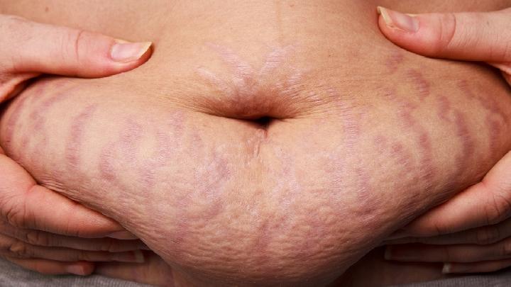 如何判斷花粉過敏癥狀 兩招判斷自己是否是花粉過敏