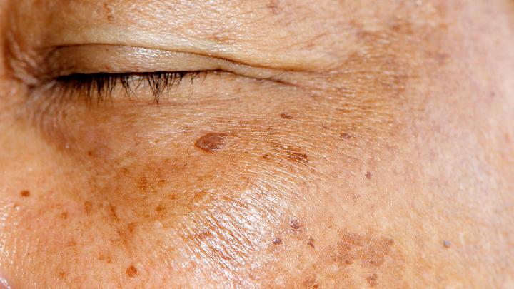 春季養(yǎng)生皮膚過(guò)敏怎么辦最好 皮膚過(guò)敏的兩個(gè)要素要知道