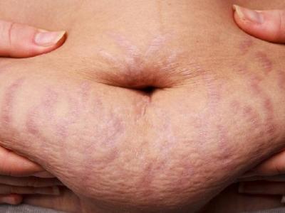 如何判斷花粉過(guò)敏癥狀 兩招判斷自己是否是花粉過(guò)敏