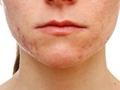 春季花粉過敏食療方有哪些 中醫應對花粉過敏食療方推薦