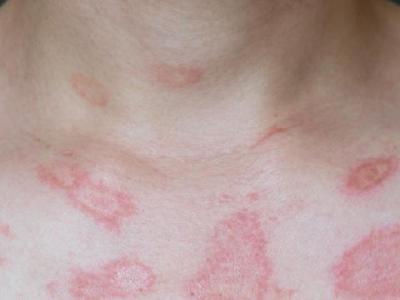 春季花粉過敏怎么預(yù)防 孕媽媽把握三原則可預(yù)防花粉過敏