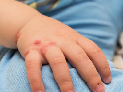 春季花粉過敏有什么方法可以防治 春季易花粉過敏中醫防治有高招