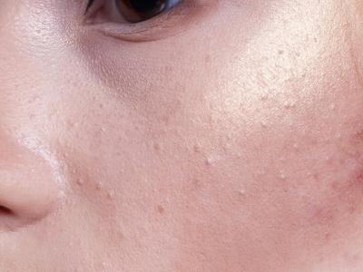 在冬季如何對皮膚進行保健