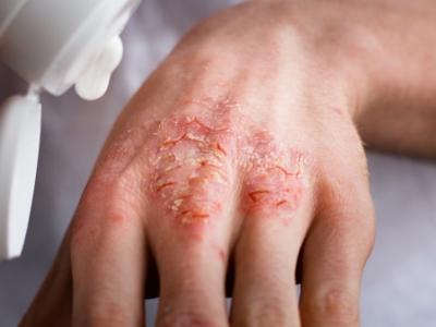 夏天皮膚曬傷怎么辦 緩解皮膚紅腫疼痛的方法