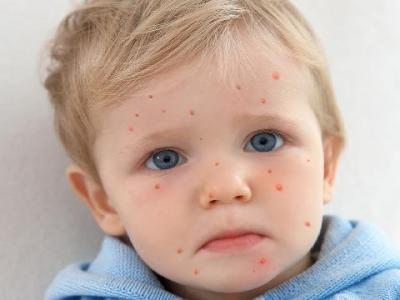 冬天穿鞋謹防濕疹 教你如何防止濕疹復發