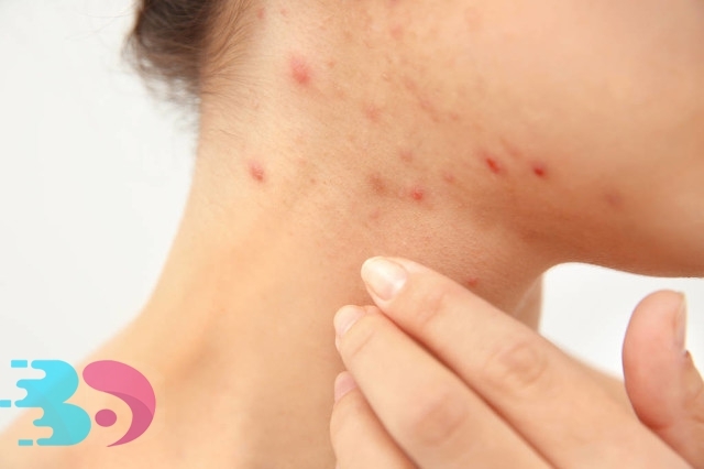 水土不服過敏多久能好，原來它還和身體素質有關!