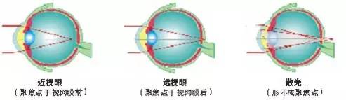 關(guān)于散光，這些你都了解嗎？
