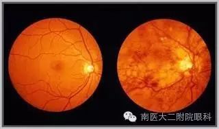 高血壓病人易出現眼底出血 高血壓病人易出現眼底出血