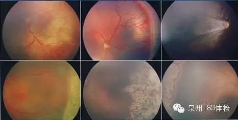 忽視糖尿病治療會致雙目失明？