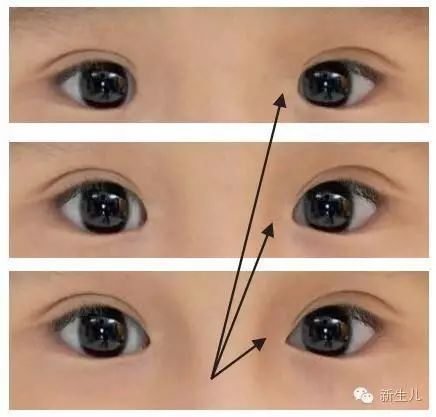 怎樣區別你的寶寶是否有斜視眼？