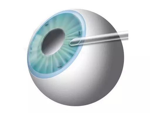 高度近視朋友需要預防六種常見并發癥