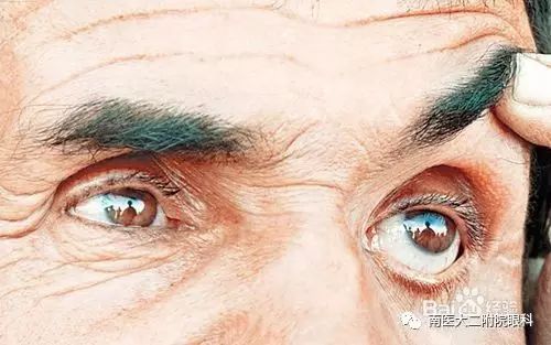 眼內(nèi)進(jìn)了異物應(yīng)當(dāng)怎么處理？