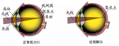 詳解近視、散光、遠(yuǎn)視、斜視及弱視 詳解近視、散光、遠(yuǎn)視、斜視及弱視