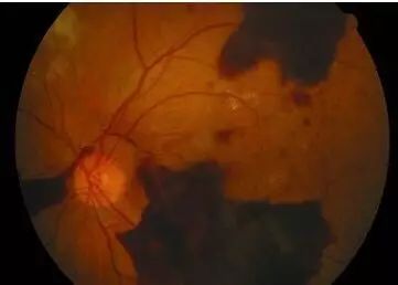 糖尿病會(huì)導(dǎo)致眼睛失明，視力模糊是前期征兆！