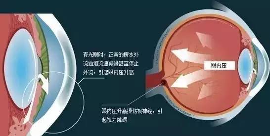 青光眼的三個危險級別，你了解嗎？