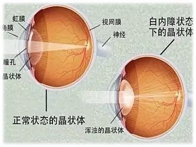 中老年人患白內障的真相是什么? 中老年人患白內障的真相是什么?