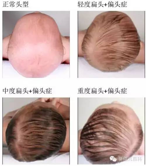 孩子的頭型與睡枕頭有關(guān)系嗎？