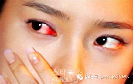 眼睛充血是怎么回事?