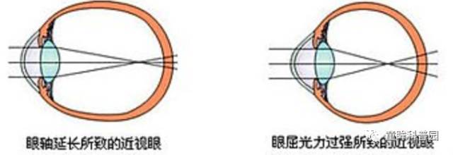 你不得不知的兒童近視幾大問(wèn)題