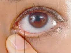 點眼藥水的正確步驟和姿勢 點眼藥水的正確步驟和姿勢