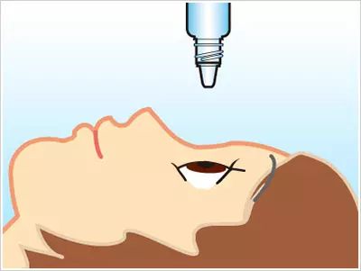 近視手術要多久才能恢復視力？恢復期間會不會影響正常生活？