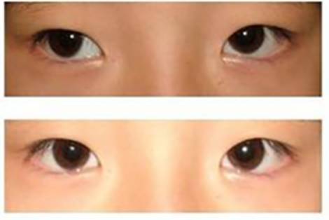 孩子眼睛模糊，就是近視？