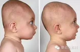 孩子的頭型與睡枕頭有關(guān)系嗎？