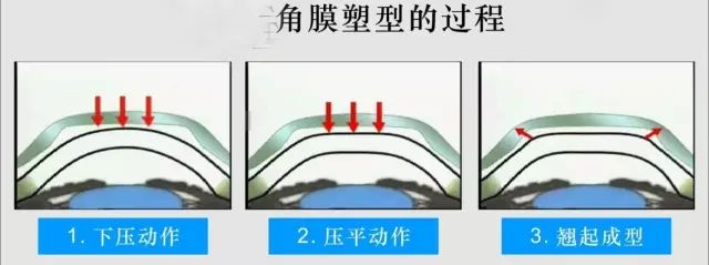 孩子近視又加深了怎么辦？