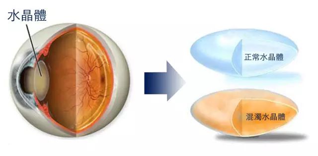 白內障初期的六大警報，五類高發人群